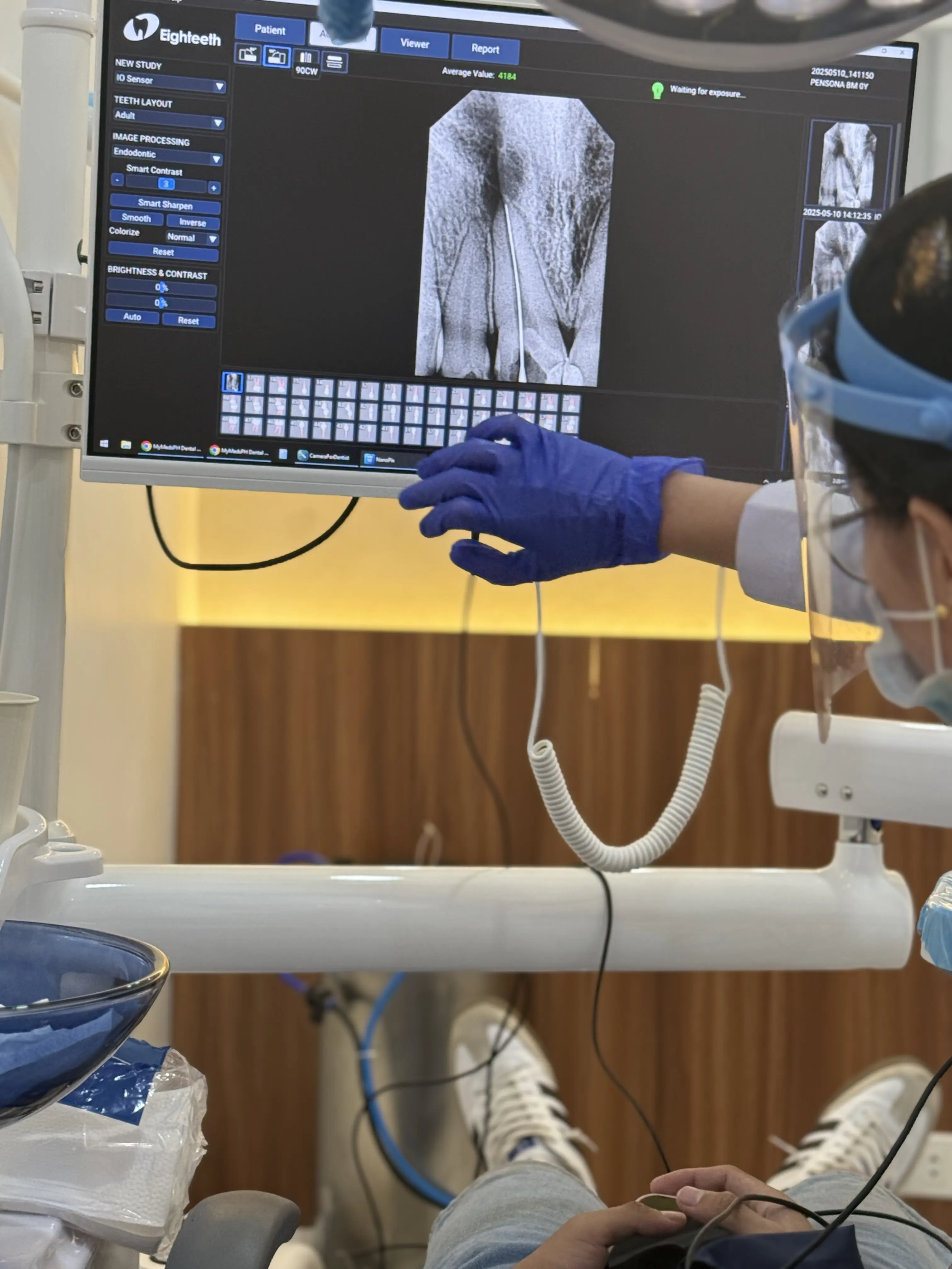 Periapical X-Ray - 4