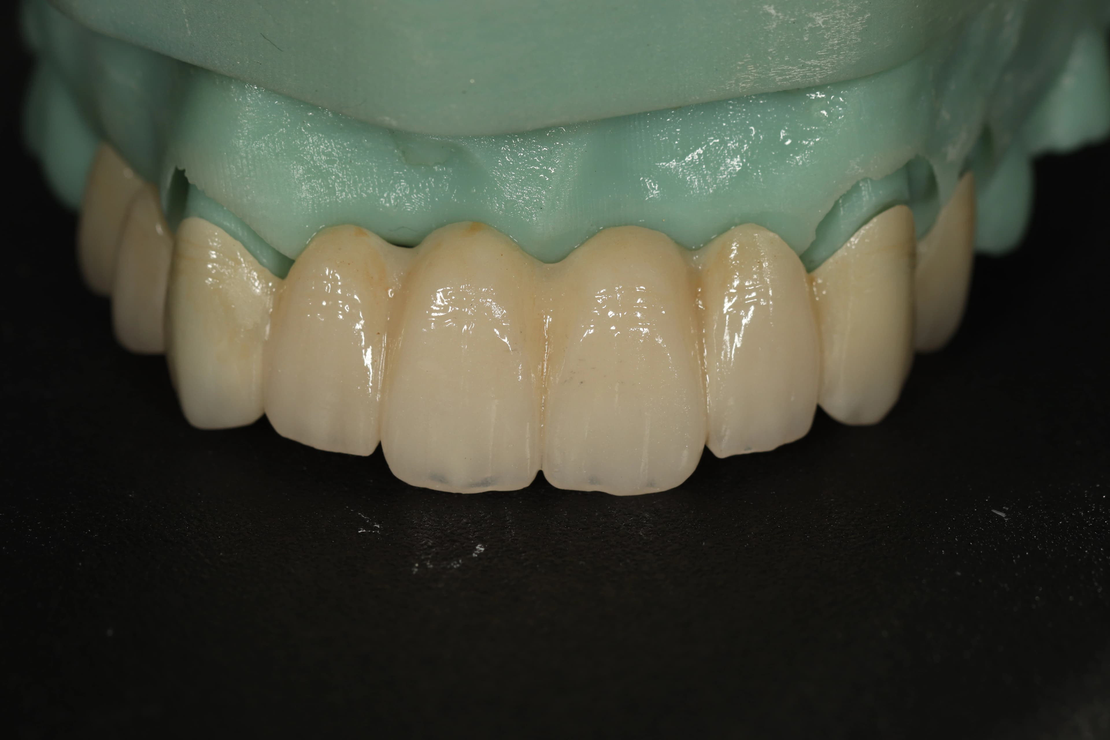 Full mouth reconstruction evaluation at Legacy Smiles
