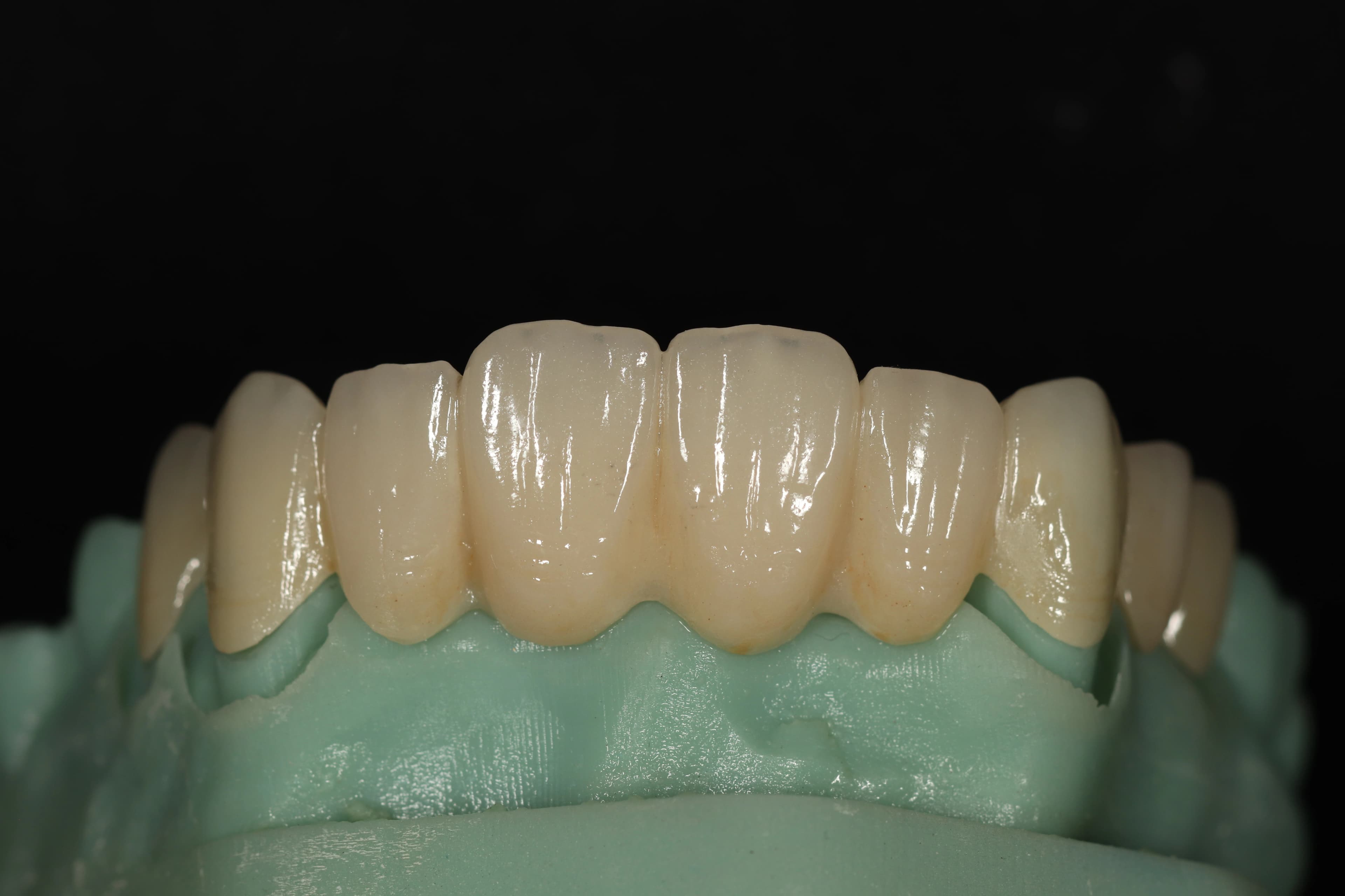 Full mouth reconstruction result