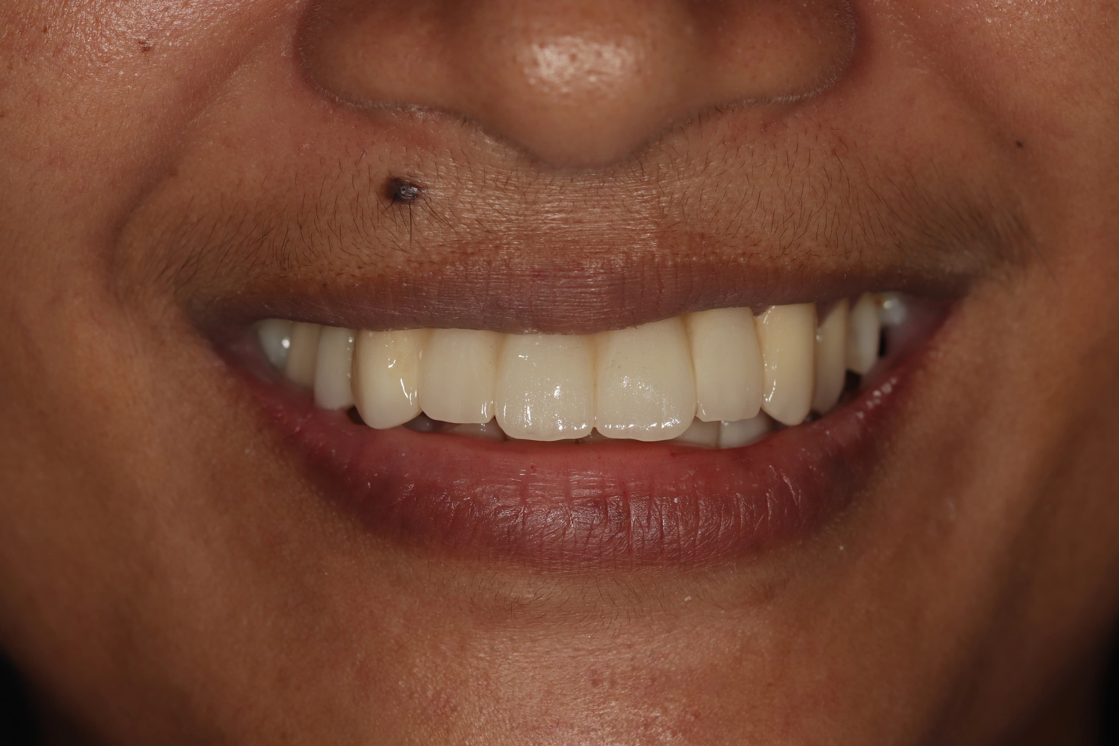 Full mouth reconstruction result