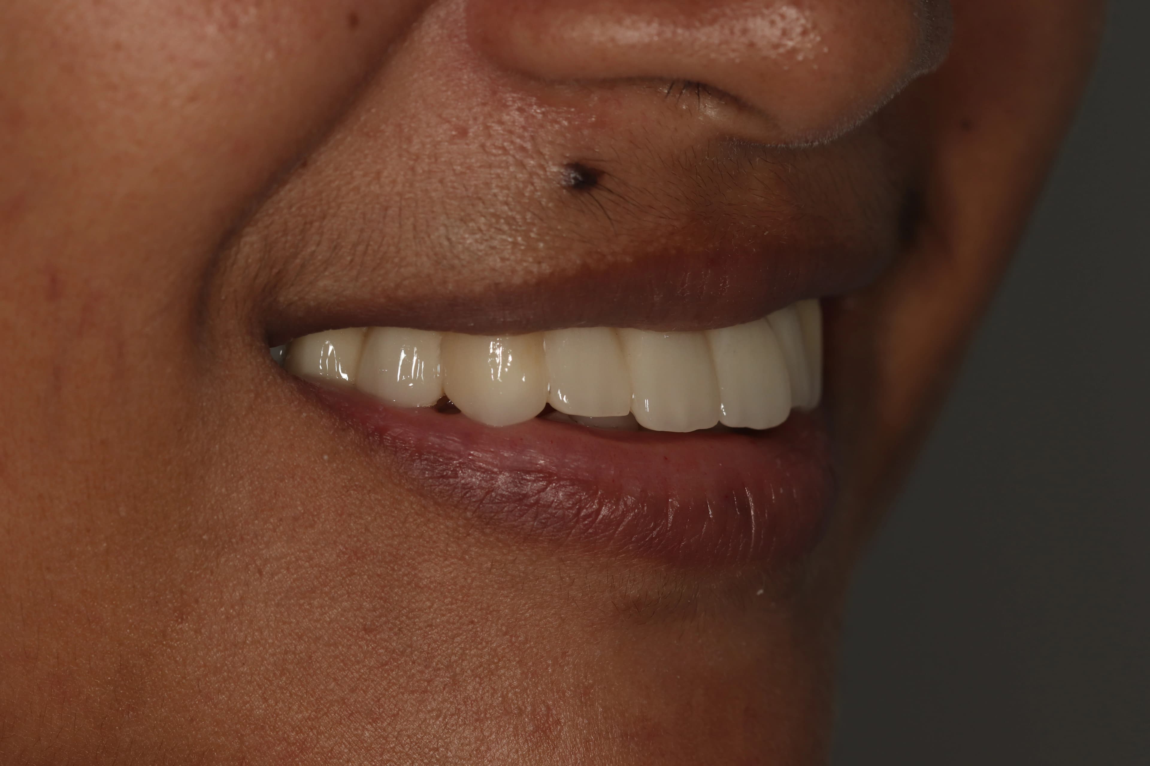 Full mouth reconstruction result